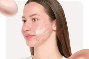 Understand your blemishes with us.